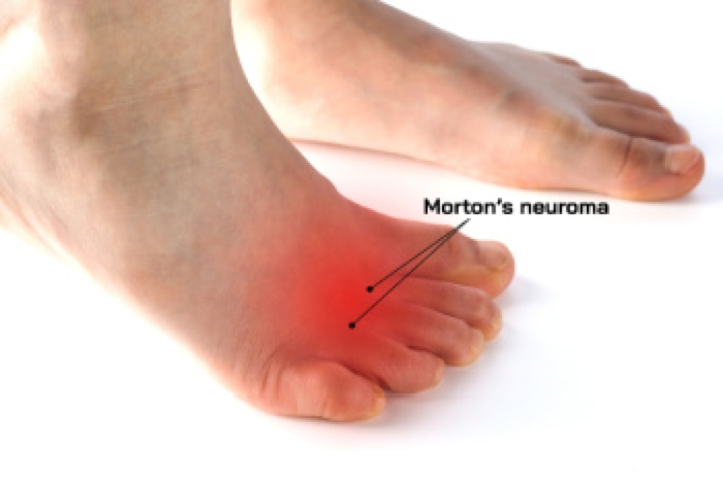 Symptoms and Treatment of Morton's Neuroma