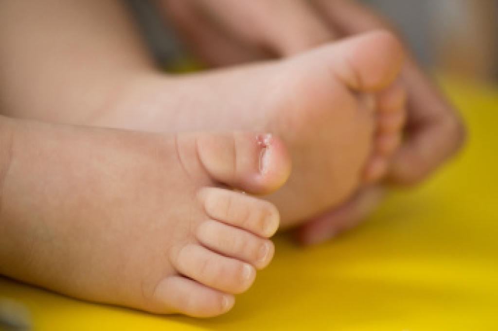 Early Warning Signs of Ingrown Toenails in Children