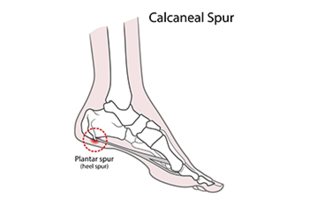 How Heel Spurs Can Cause Pain While Walking