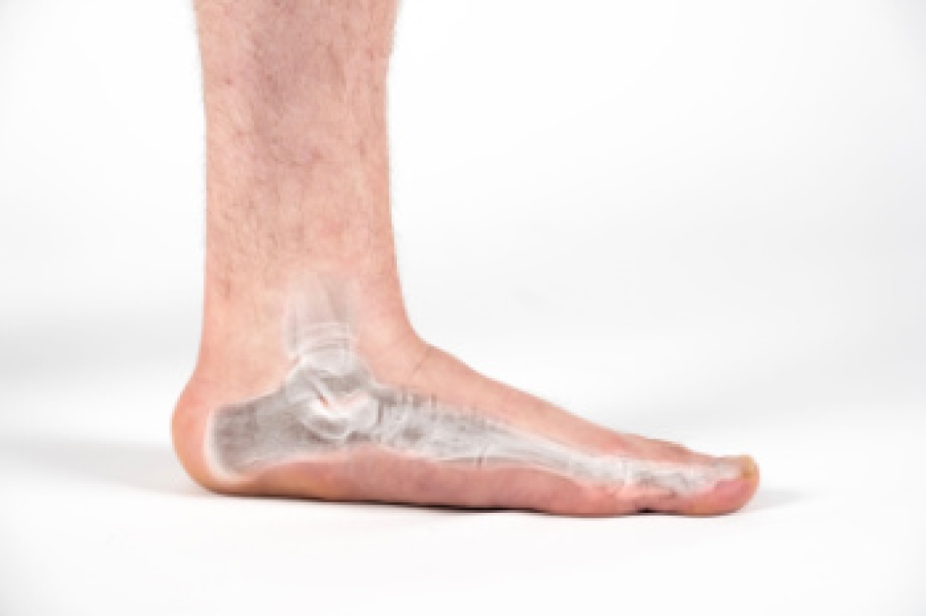 Flat Feet and Podiatric Care
