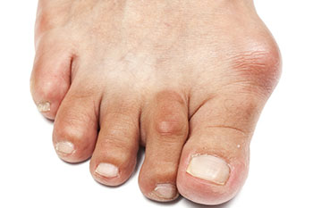 bunions treatment in the Bellaire, TX 77401 area