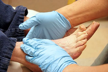 diabetic foot treatment in the Bellaire, TX 77401 area