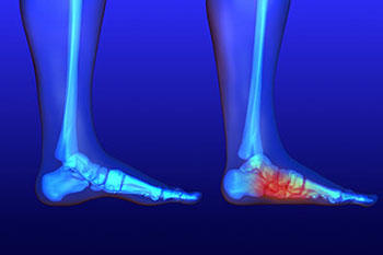 Flat feet and Fallen Arches treatment in the Bellaire, TX 77401 area