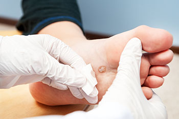 Plantar warts treatment in the Bellaire, TX 77401 area