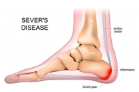 Definition and Symptoms of Sever’s Disease